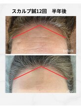 ココハリ/スカルプ鍼　半年後