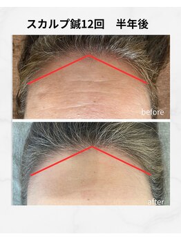 ココハリ/スカルプ鍼 半年後