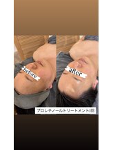 クラン(CLAN)/プロレチノールトリートメント