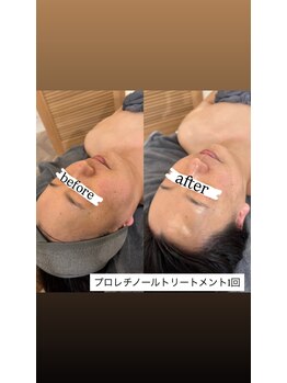 クラン(CLAN)/プロレチノールトリートメント
