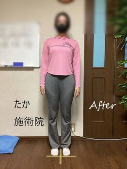 たか施術院/美姿勢矯正 10代 2回目