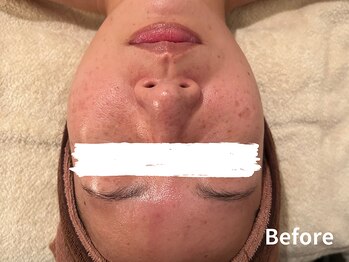 ダイヤモンド リーエンダ(Diamond leende)/クレイハーブピーリング