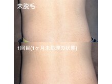 エピジュ(Epijyu)/男性の腰脱毛