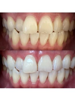 ワールドビューティー(World Beauty)/プレミアムホワイトニング