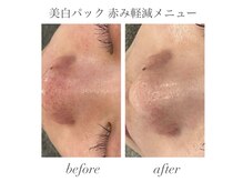 エミナル(EMINAL)/美白パック＋赤み軽減メニュー