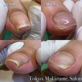 巻き爪補正店 大分店