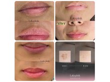 色シミや黒ずみ１回の施術でケアしませんか？