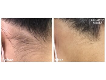 リッカ 学芸大学(RIKKA)/うなじ脱毛