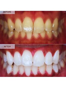 スマイルホワイト 赤羽店の写真/今だけ！プランお申し込みで医療提携ジェルホワイトニング3万円相当が無料に！