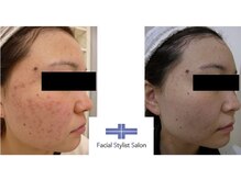 フェイシャルスタイリストサロン 高崎店(Facial Stylist Salon)/ケア例（6）