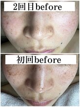 ティーツリー 名古屋 桜山(Tea Tree)/１回でここまで変わるシミケア