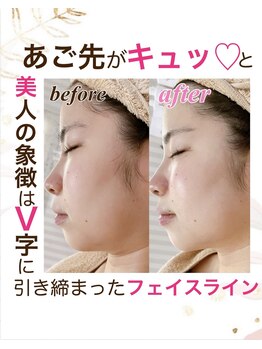 ソワンドビジュー(soin de bijew)/極上のインディバフェイシャル