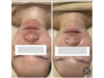 ルル(RuRu)/REVI陶肌トリートメント