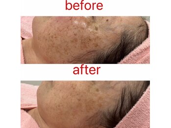 エステサロン ブレス 山形店(BLESS)/フェイシャル結果