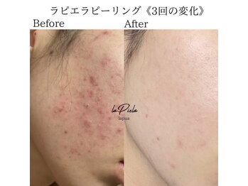 ラナ(Lana)/ラピエラピーリング