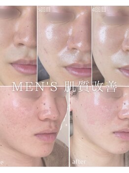 ルリエベル(Relier Belle)/肌悩み諦めないで