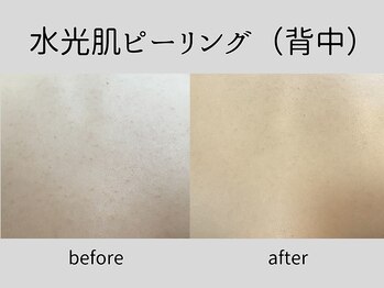 マーベル(MaaBelle)/20代/水光肌ピーリング(背中)