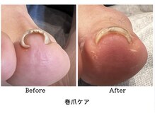 アンベリール(embellir.)/巻爪ケア