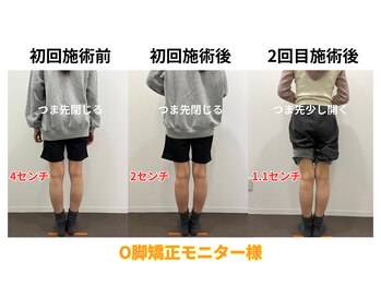 なおちゃん整骨院 整体院/O脚矯正モニター様