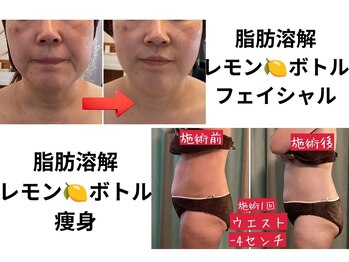 ファム 蓮台寺店(FAM)の写真/【リピーター続出!脂肪分解レモンボトル】レモンボトル痩身は脂肪を効率よく分解☆早く結果を出したい方に!