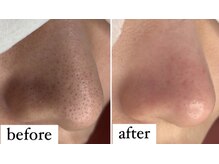 エミング(yeming)/★毛穴エクストラクション★