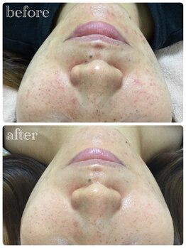 メイユール(MEILLEUR)/光フェイシャル＋スキンケア