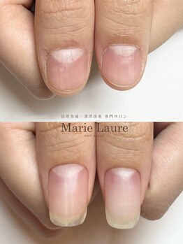 マリーロール 梅田店(Marie Laure)/自爪育成/深爪矯正/ネイルケア