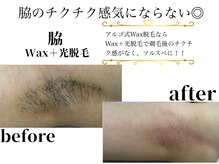 アルゴ 八幡黒崎店(ALGO)/アルゴ式WAX脱毛＋光脱毛