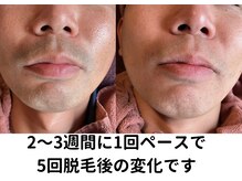 ビエスト(美est)/ヒゲ脱毛