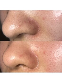 フーフロー(Fooflow)/毛穴洗浄