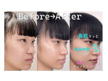 ラプリ 横浜店(Raplit)/隆鼻+輪郭矯正40分