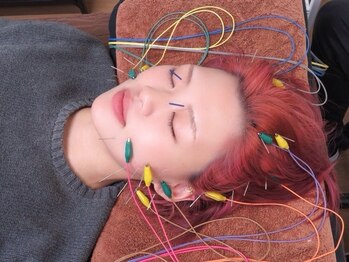 松尾美容鍼灸×整体 香椎/電気鍼施術風景です。