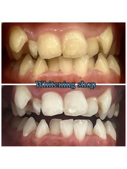 ホワイトニングショップ 池田店/【BEFORE/AFTER】