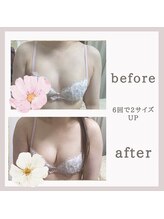 アリサナ(Arisana)/症例写真　バスト　葛西