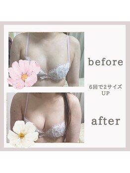 アリサナ(Arisana)/症例写真　バスト　葛西