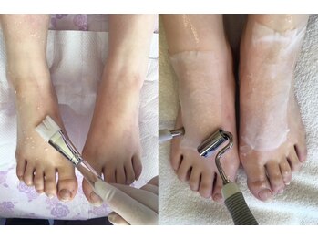 メニュ画像;足甲美白美容液導入