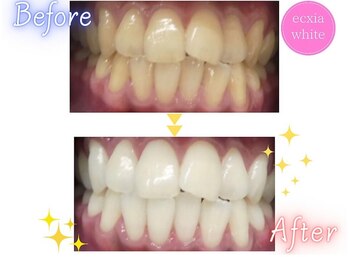 エクシアホワイトニング 心斎橋店/ホワイトニングビフォーアフター