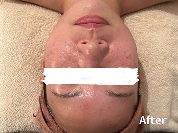 ダイヤモンド リーエンダ(Diamond leende)/クレイハーブピーリング