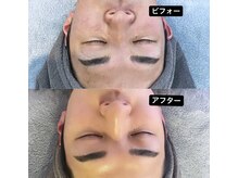 ディライト 名古屋駅店(Delight)/ハーブピーリング陶肌TR