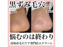 エクラーレ(Eclale)/【毛穴ケア】症例