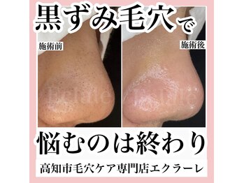 エクラーレ(Eclale)/【毛穴ケア】症例