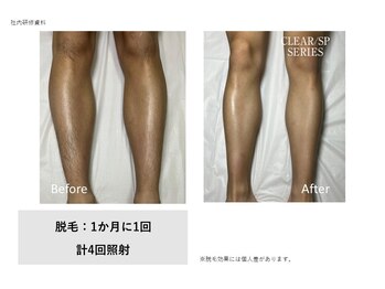 フェレザ 新潟(Felleza)/セルフ脱毛が初めてでも◎