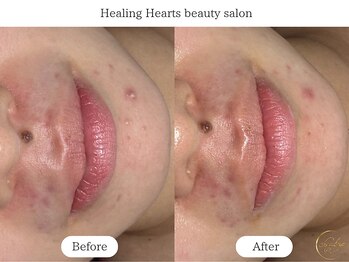ヒーリングハーツ(Healing Hearts)/1回での変化 繰り返しニキビ改善