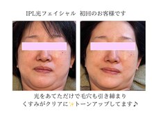 ディアレスト(Dearest)/IPL光フェイシャル &nbsp;初回