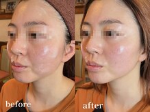 エピリス(Epiliss)/頬肉スッキリビフォーアフター