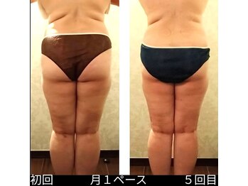 バービーホリック(barbie holic)/１６０コース　初回と５回目比較