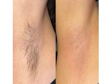 ビューティーバーコア(Beauty bar KOA)/ワックス脱毛【脇】
