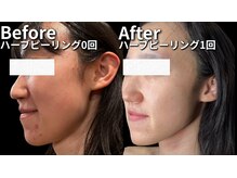 美意識/ニキビ肌改善！