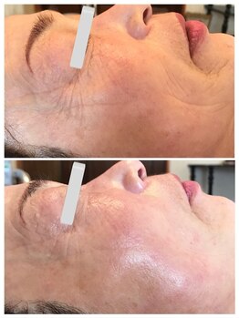 ルミナス(luminous)/しわ改善