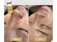 エステダーマ/ハイドロ等の肌質改善に特化した施術豊富◎